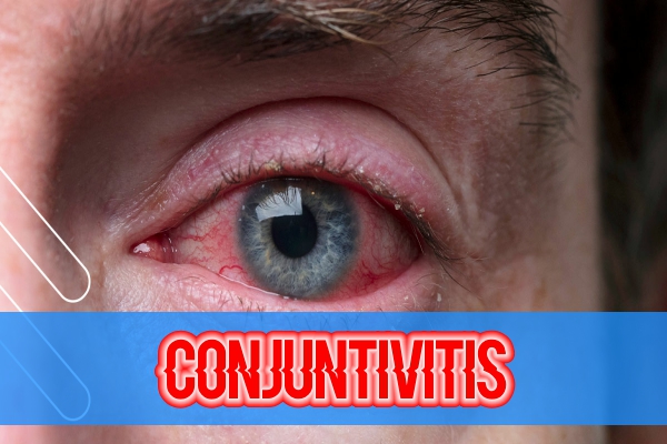 Conjuntivitis Clinica Hispana Mangum